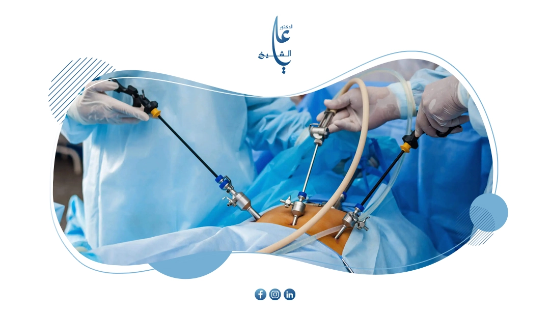 استئصال الزائدة الدودية بالمنظار: الدليل الطبي الشامل