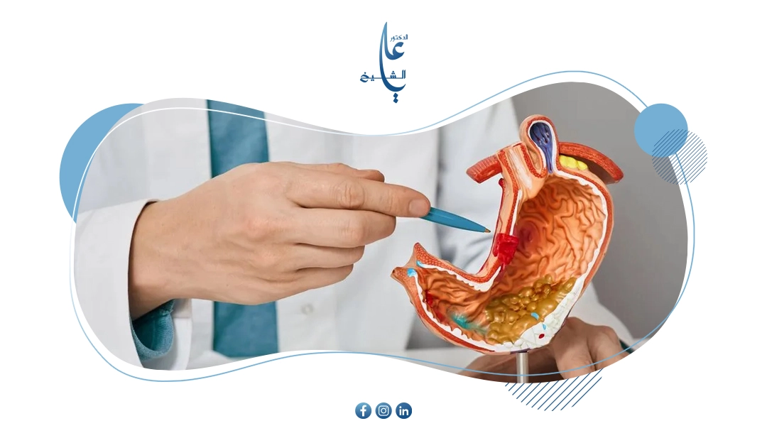 متى يزول خطر التسريب بعد التكميم؟