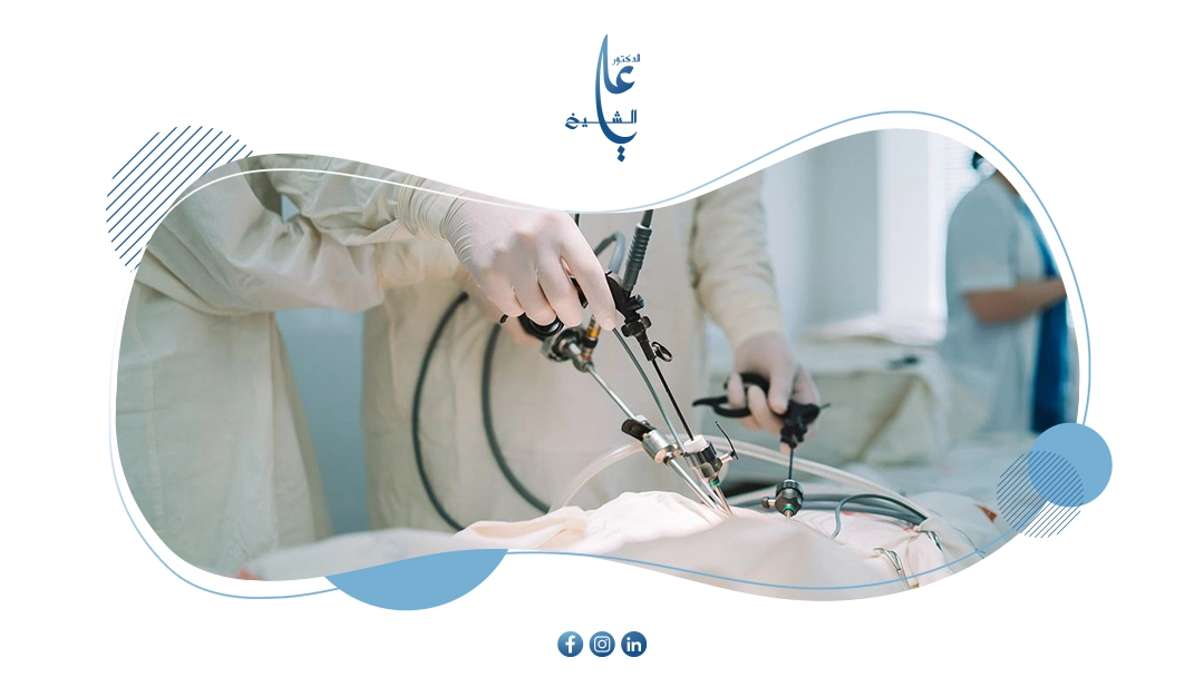 تفتيت حصوات المرارة بالمنظار