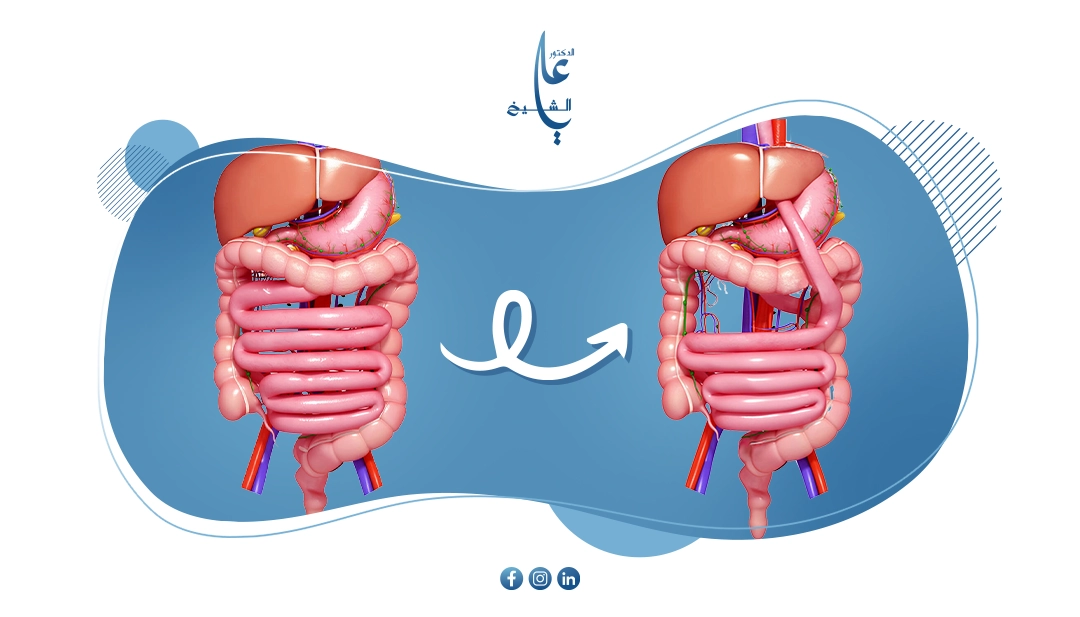عملية تحويل مسار المعدة: ما له وما عليه