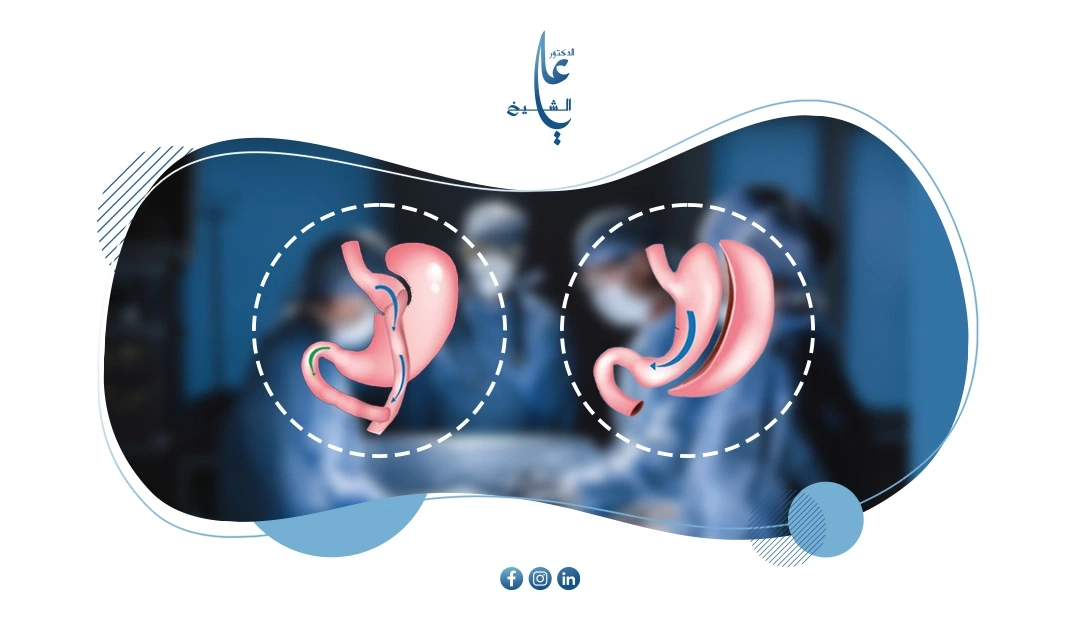 الفرق بين تحويل المسار وتكميم المعدة بالتفصيل: دليلك لاتخاذ القرار الصحيح