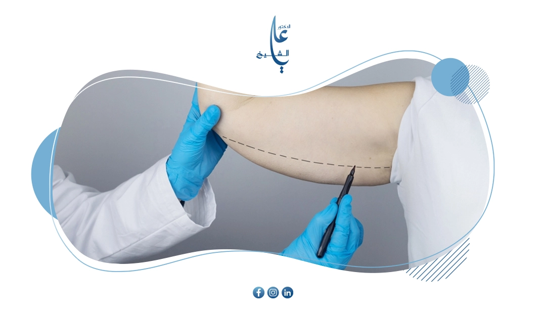 مشكلة جراحات التجميل بعد عمليات السمنة - هل يوجد حلول بديلة؟