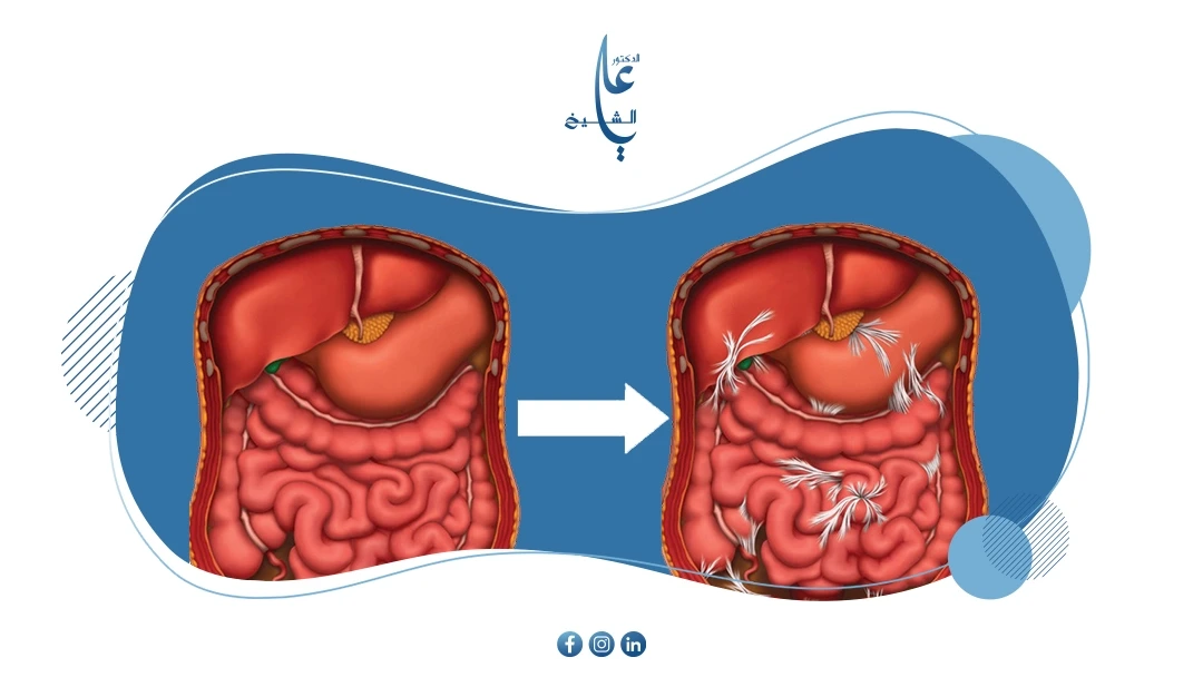 الالتصاقات بعد العملية الجراحية: الأسباب، الأعراض، الوقاية والعلاج