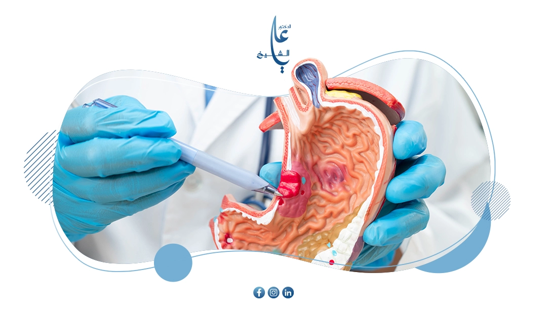 جراحات الجهاز الهضمي | الأنواع، التقنيات، وفترة التعافي