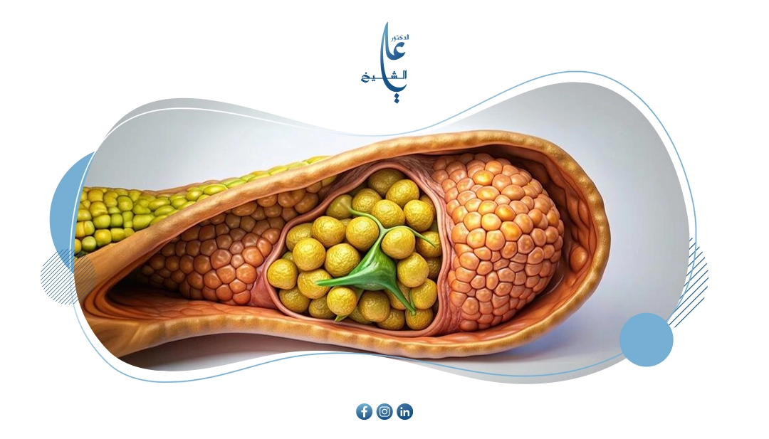 كل ما تحتاج معرفته عن حصوات المرارة وأعراضها وعلاجها بدون جراحة