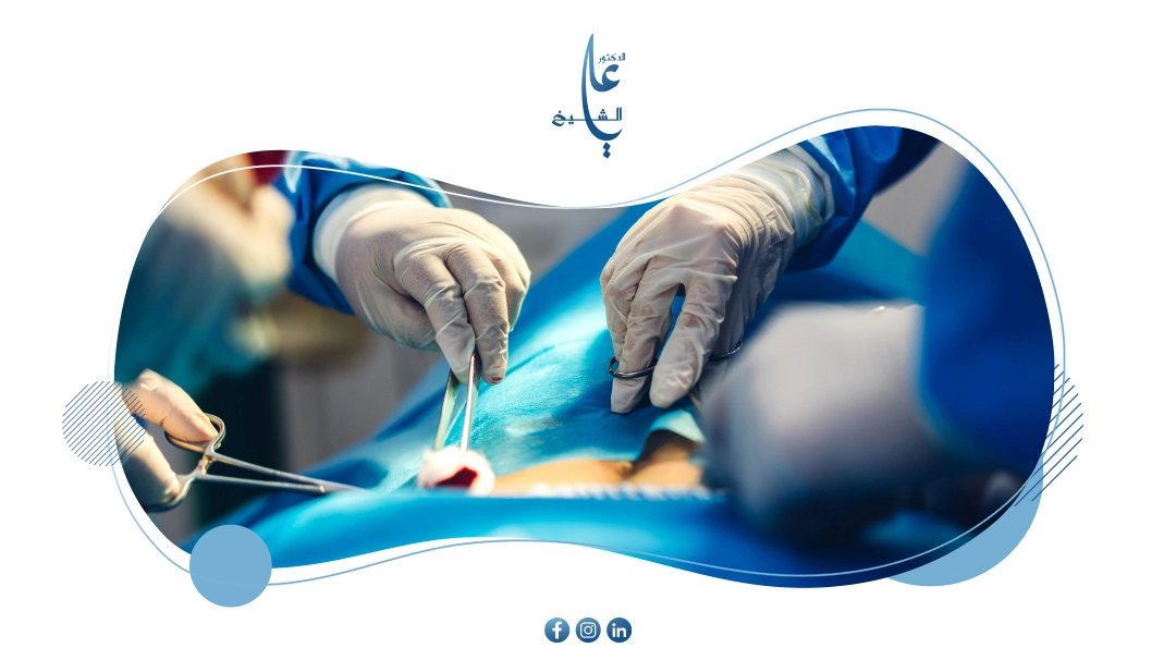 أنواع عملية تكميم المعدة وأهم الفروقات بينها