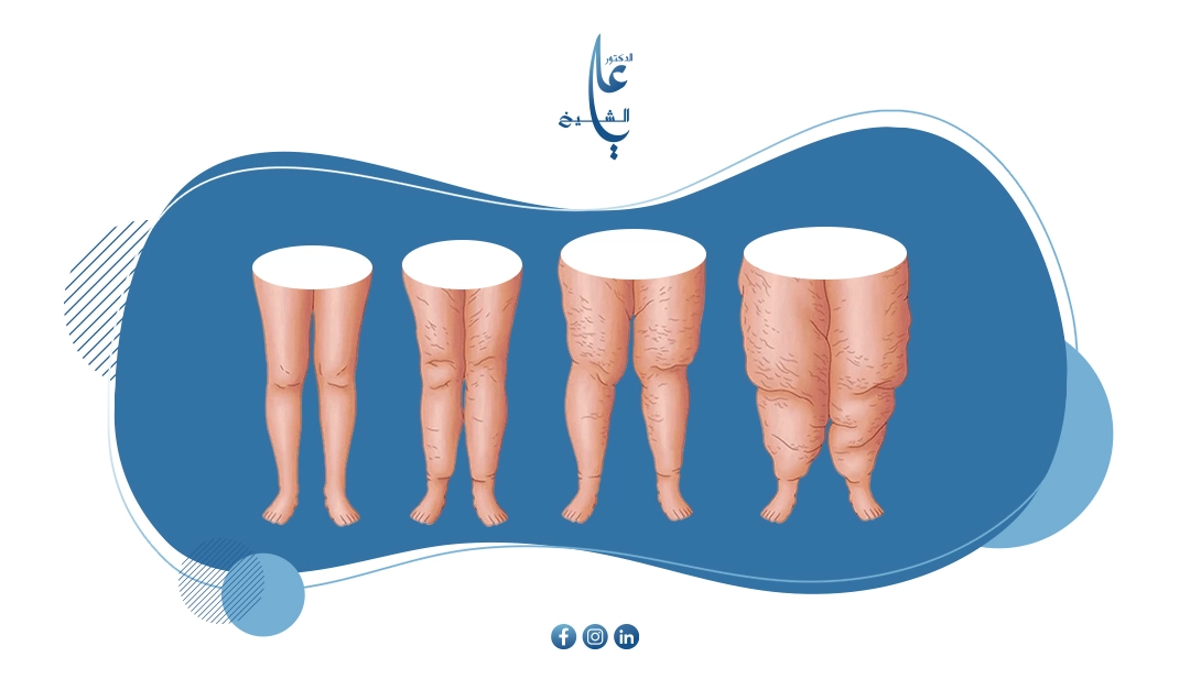 الوذمة الشحمية: دليلك الشامل لفهم الأعراض، الأسباب وخيارات العلاج
