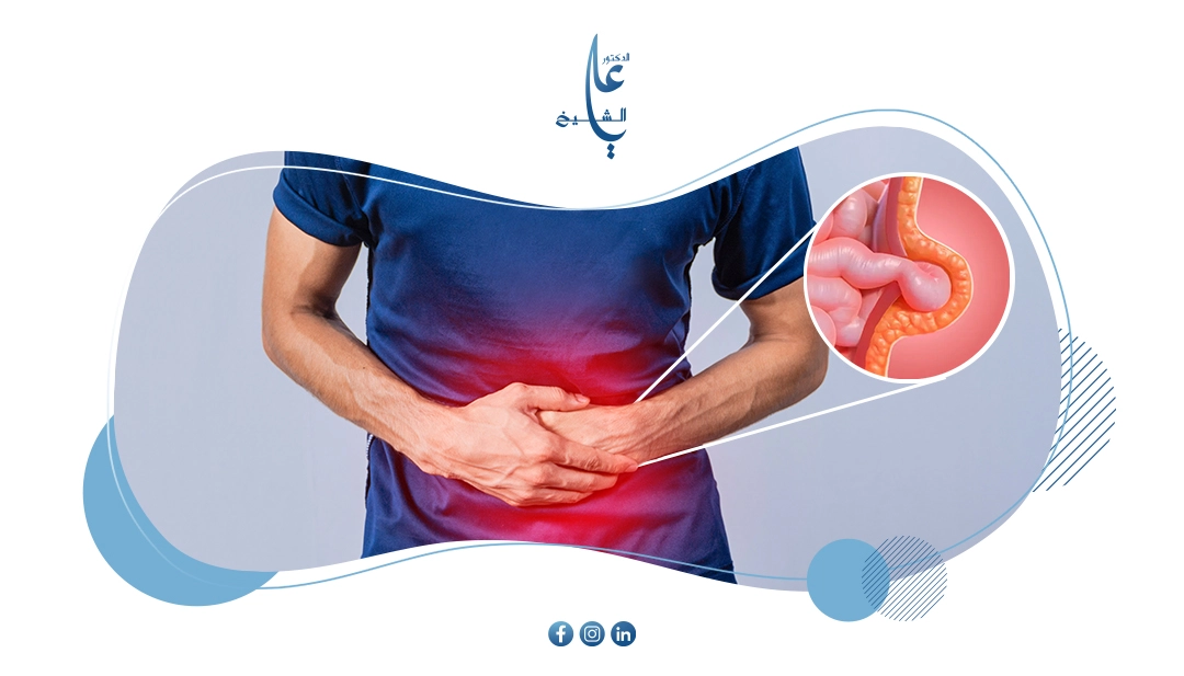 دليل أنواع فتق البطن: التشخيص، الأعراض و خيارات العلاج الجراحي