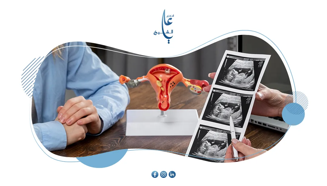 ما هي متلازمة المبيض متعدد الكيسات (PCOS)؟الأعراض، والعلاج