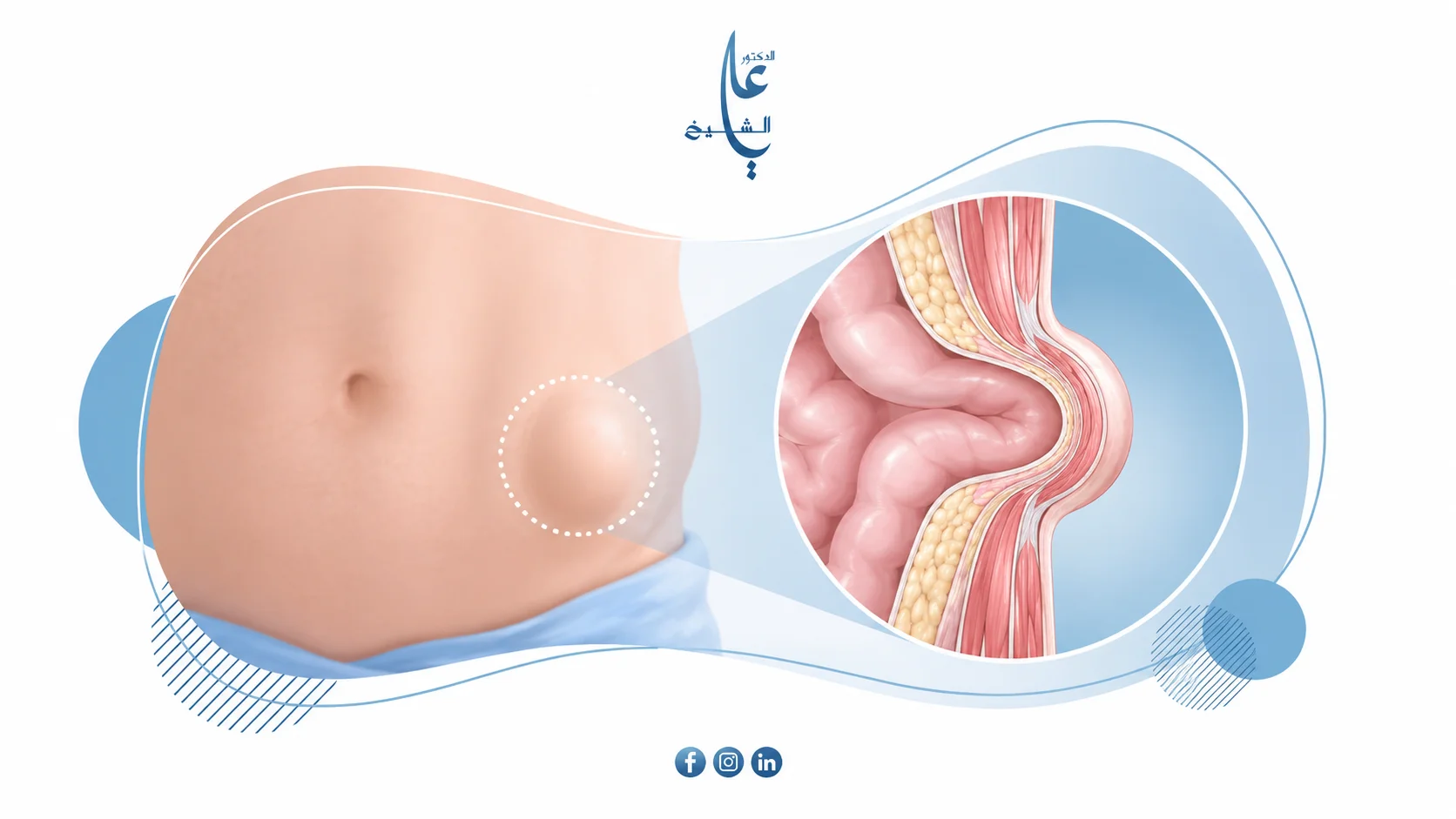 هل الفتق يحتاج عملية دائماً؟ متى يمكن الانتظار ومتى يصبح خطراً؟