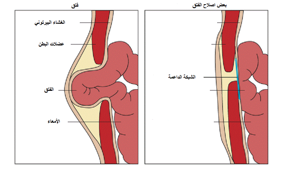 إصلاح الفتق