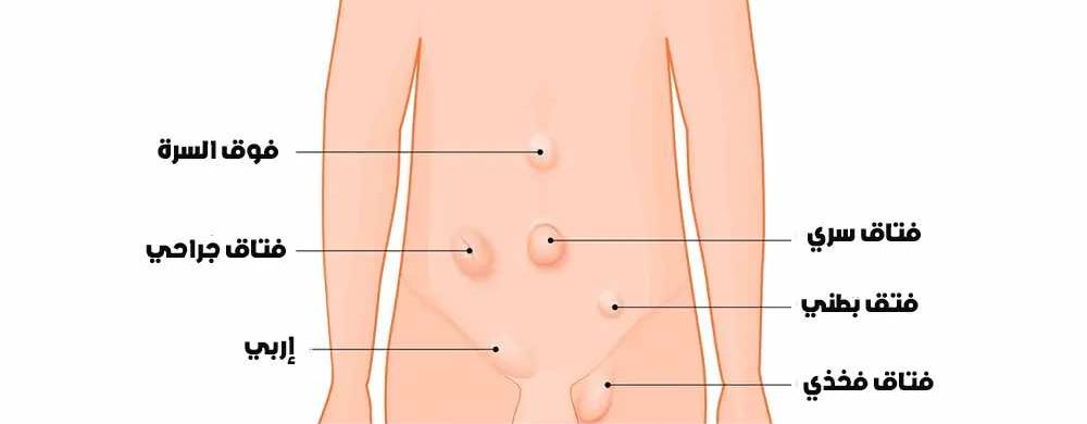 أنواع فتق البطن