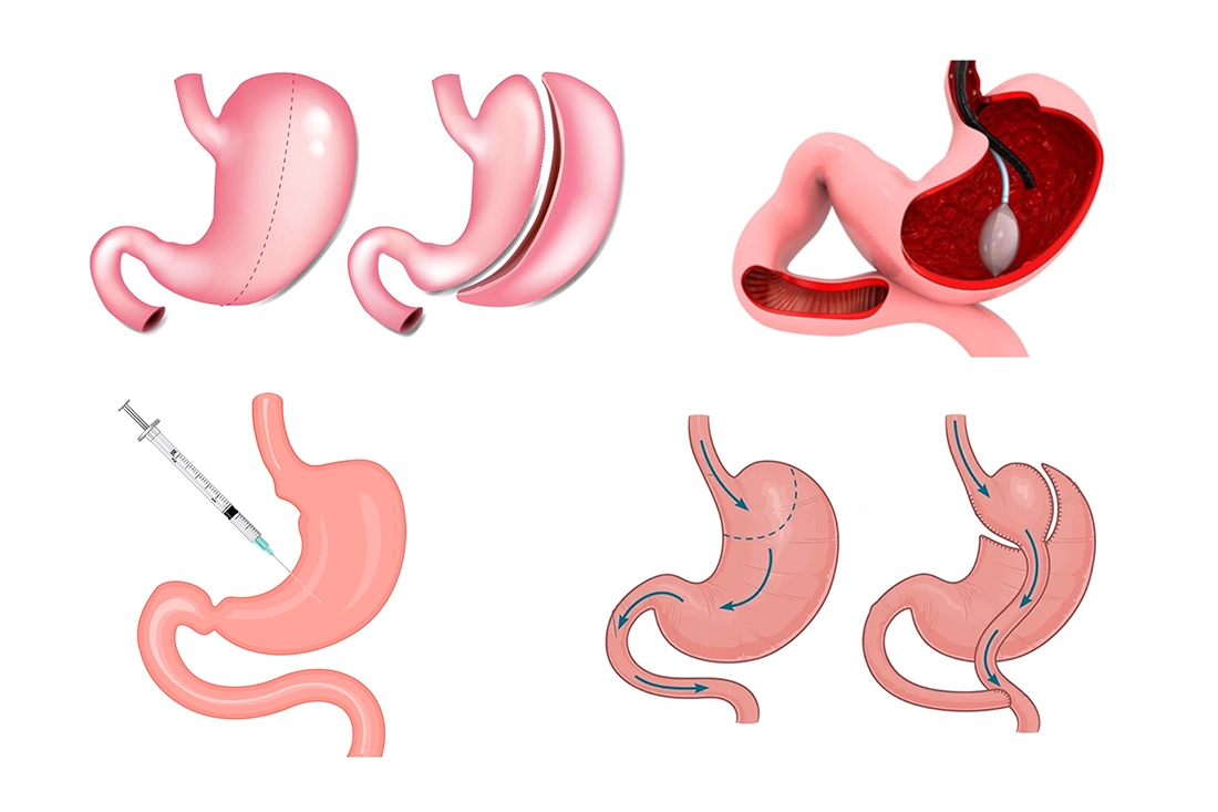 انواع جراحات السمنة