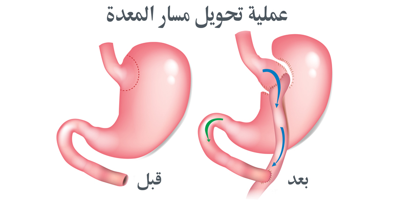 تحويل مسار المعدة