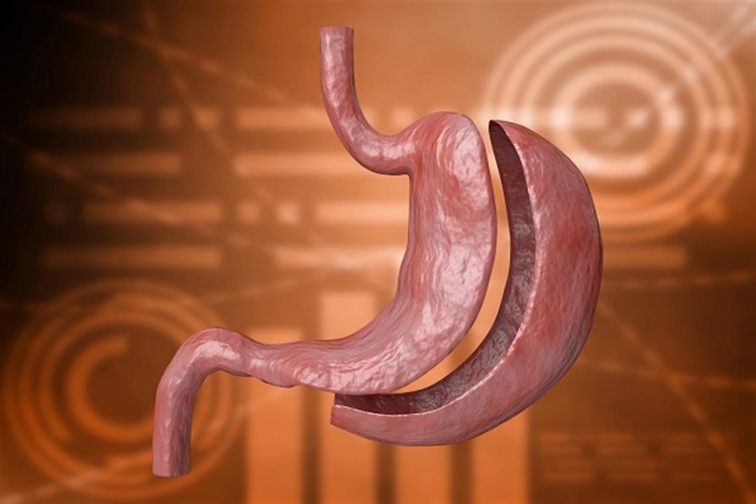 تكميم المعدة لمرضى القلب