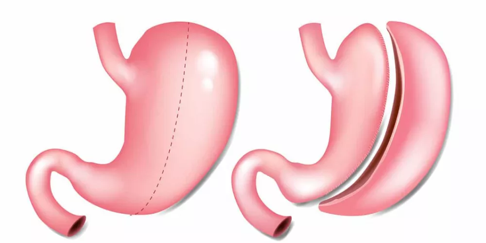 ثبات الوزن بعد التكميم