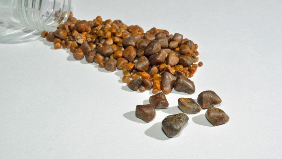 حصوات المرارة