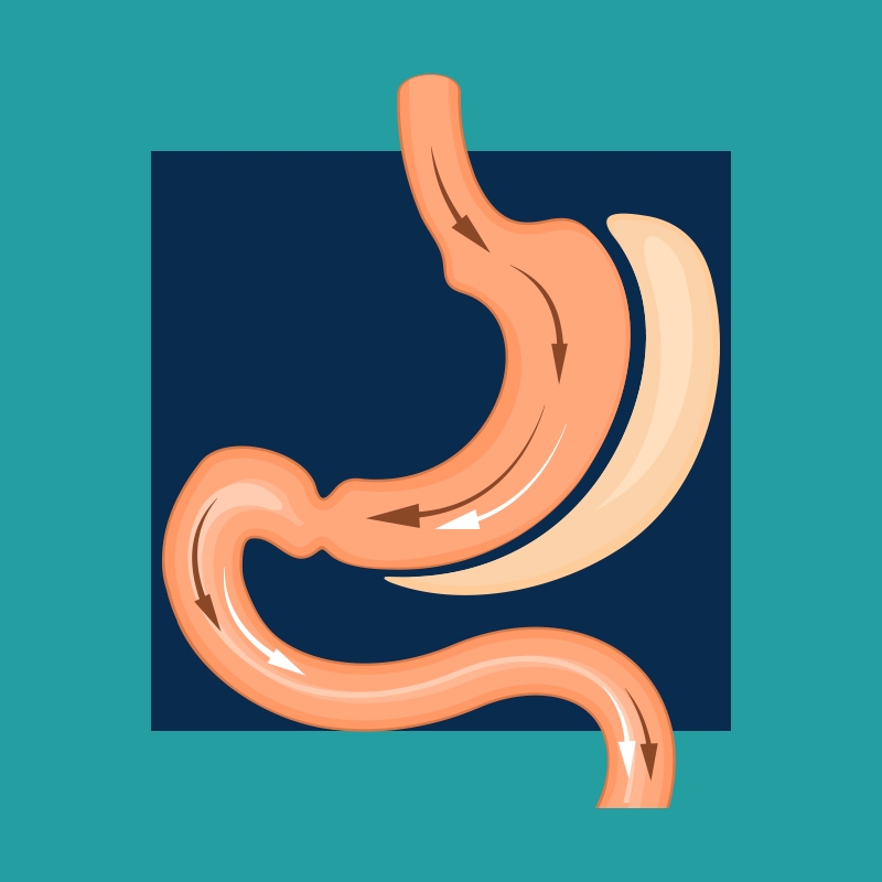 عملية التكميم لمرضى القلب